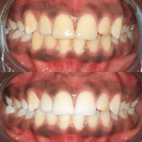 ✨Teeth Whitening Powder – Advanced PAP+ Formula for a Radiant, Healthy Smile